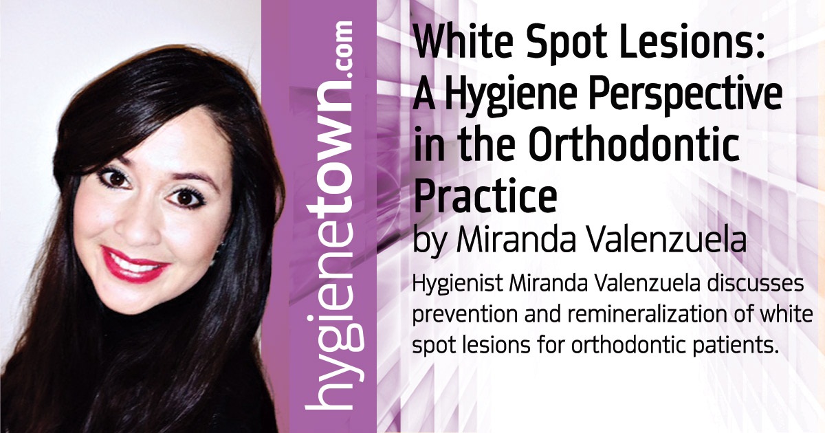 White Spot Lesions: A Hygiene Perspective in the Orthodontic Practice Hygienist Miranda Valenzuela discusses prevention and remineralization of white spot lesions for orthodontic patients.